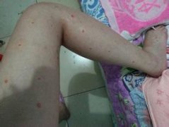 ��ͼʶ��ţƤѢ����֢״ͼ