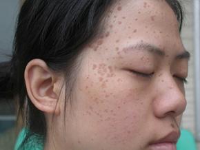 ��ƽ���֢״����Щ